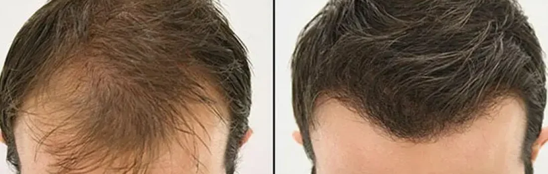 hair-transplant-in-turkey