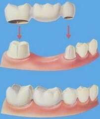 teeth in an hour, dental implants marmaris turkey