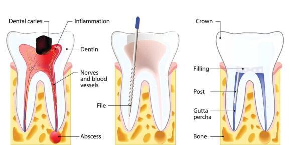 root-canal-illustration marmaris dental center