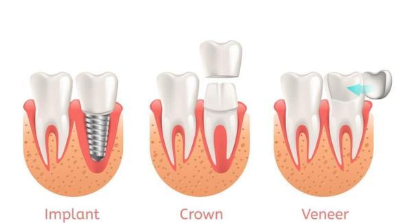 Teeth Procedure of Implant Veneer Crown Restoration. Vector Illustration Poster with Process Stomatology Prosthesis. 3d Realistic dental Banner.
