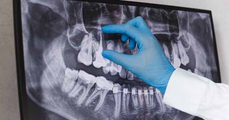 Root canal vs Extraction