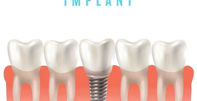 How much does it cost to get a full mouth of dental implants in Turkey How much does it cost to get a full mouth of dental implants in Turkey