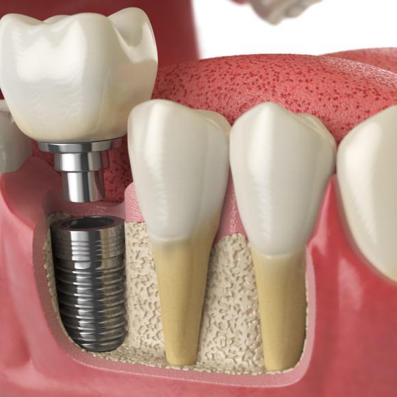 How much does a full set of teeth implants cost in Turkey?