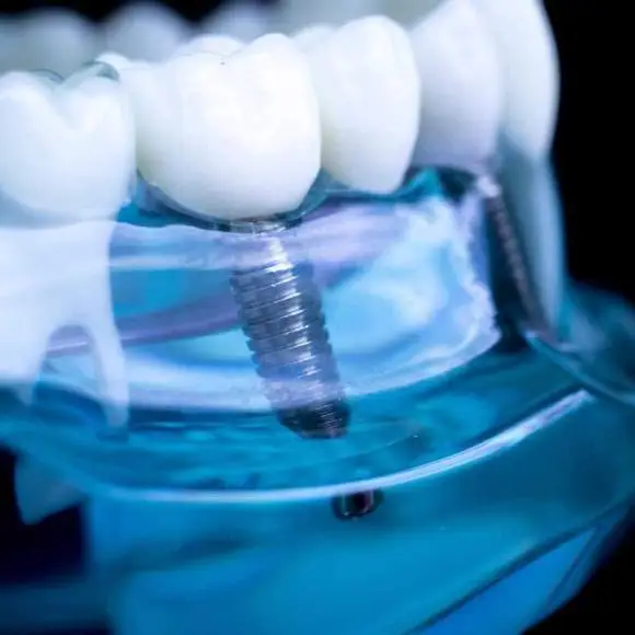 How Long Do Dental Implants Last? Lifespan, Maintenance & Long-Term Care