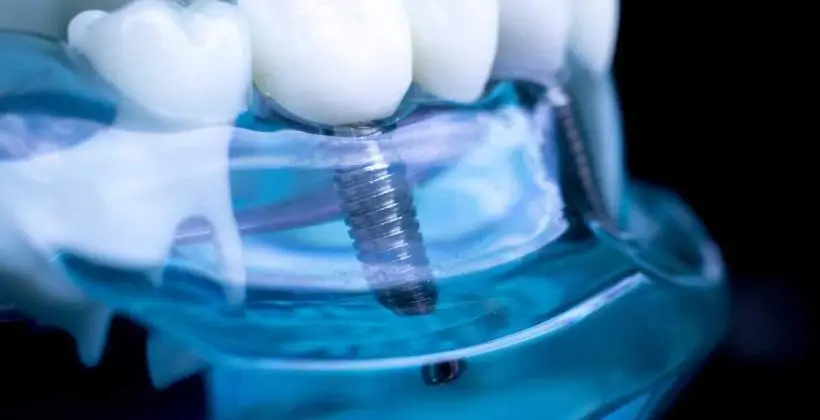 How Long Do Dental Implants Last? Lifespan, Maintenance & Long-Term Care How Long Do Dental Implants Last? Lifespan, Maintenance & Long-Term Care