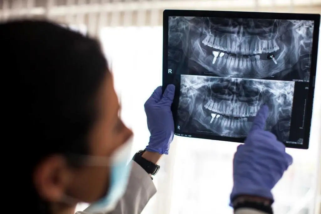 Dental implant treatment in Marmaris Turkey