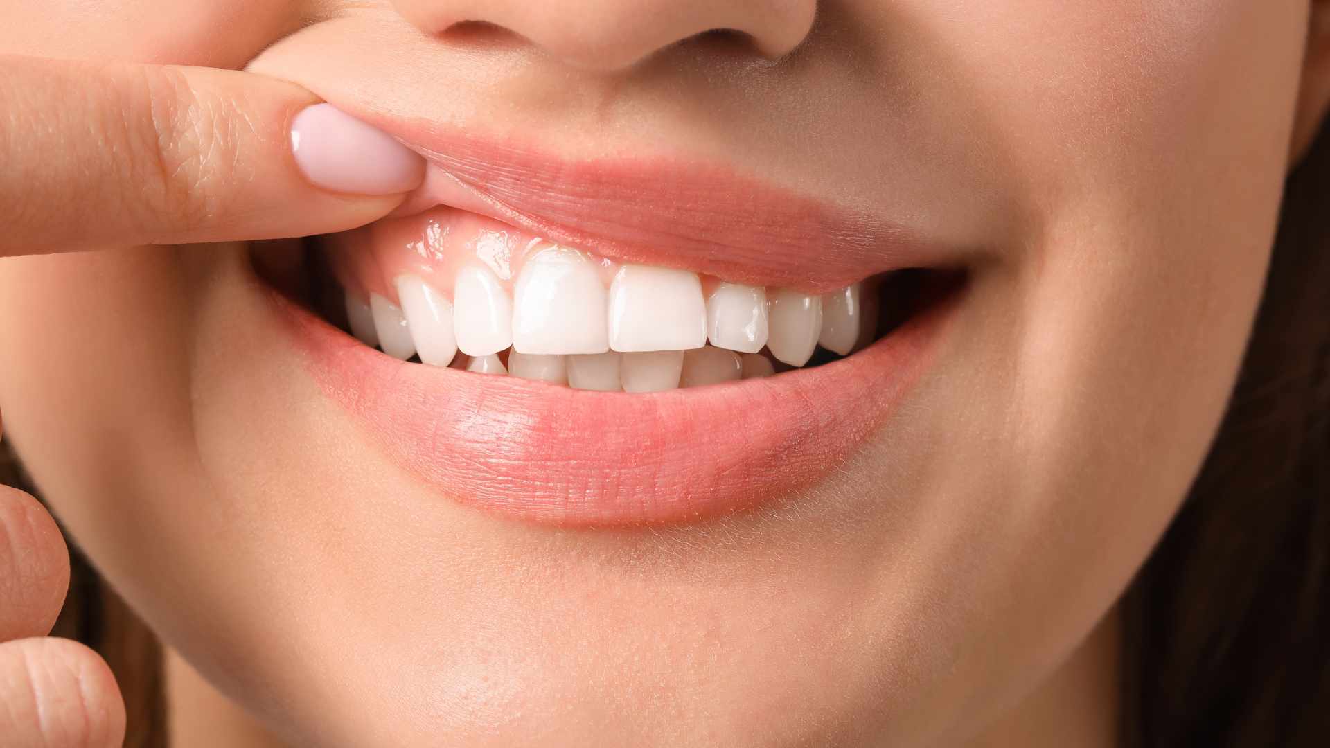 Gummy smile treatment at Marmaris Dental Center