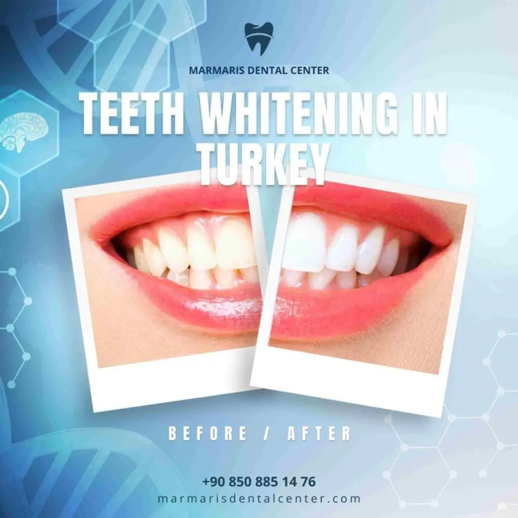 Professional teeth whitening in Marmaris Turkey
