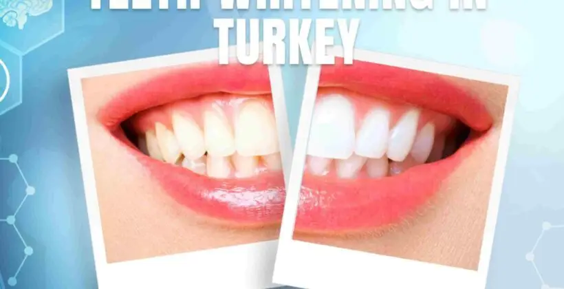 Teeth Whitening in Turkey Teeth Whitening in Turkey