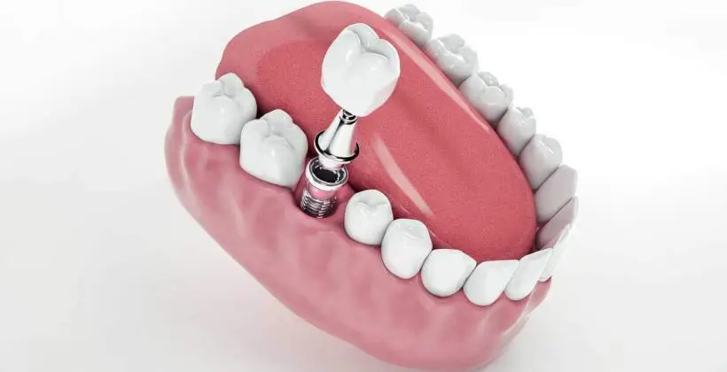 How to Get a Dental Implant and What to Expect How to Get a Dental Implant and What to Expect