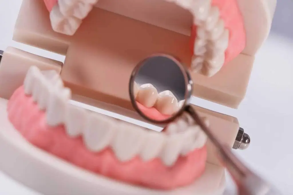 Dental bridge treatment in Marmaris Turkey