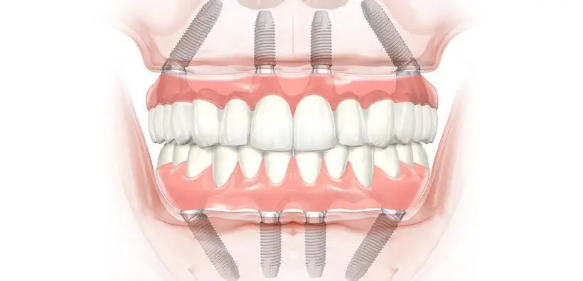All-on-4 Dental Implants and The Cost in The UK. All-on-4 Dental Implants and The Cost in The UK.