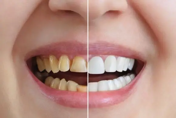 Composite Bonding or Dental Veneers: Which Is Right for You?