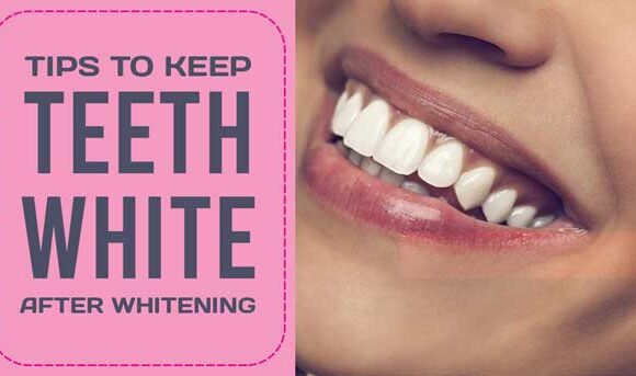 How should I maintain my teeth after whitening?