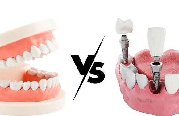 DENTURES VS. DENTAL IMPLANTS: WHICH IS BEST FOR YOU?