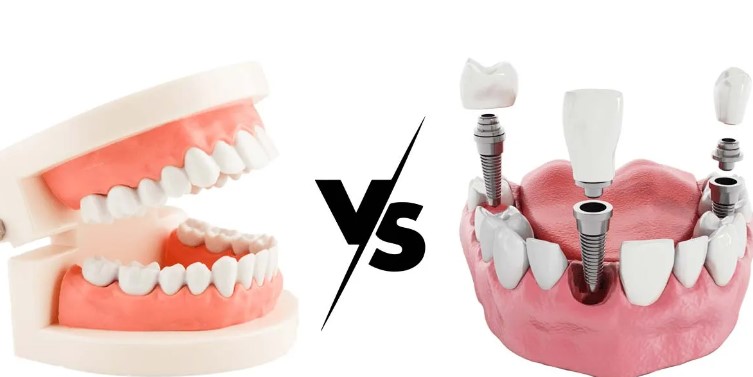 Dental Implants vs. Dentures: Making the Right Choice for Smile