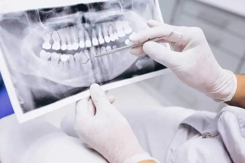 All-on-4 dental implant treatment in Turkey