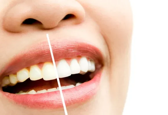 Teeth Whitening: Everything You Need to Know Before Brightening Your Smile