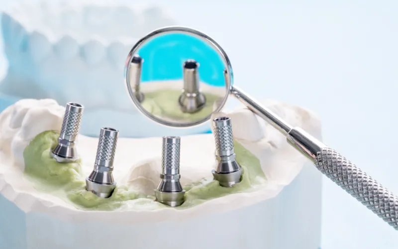 Dental implant components including abutment and screws displayed on jaw model with dental mirror