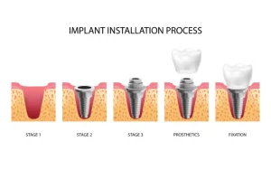Step by step dental implant installation process from placement to final crown fixation