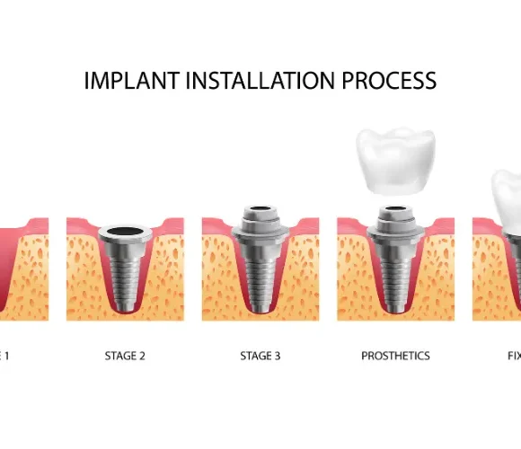 How Long Does the Dental Implant Process Take from Start to Finish?