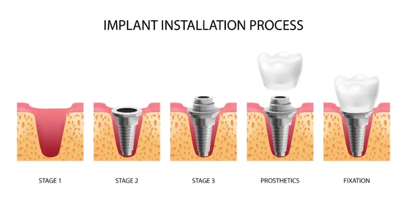 How Long Does the Dental Implant Process Take from Start to Finish? How Long Does the Dental Implant Process Take from Start to Finish?