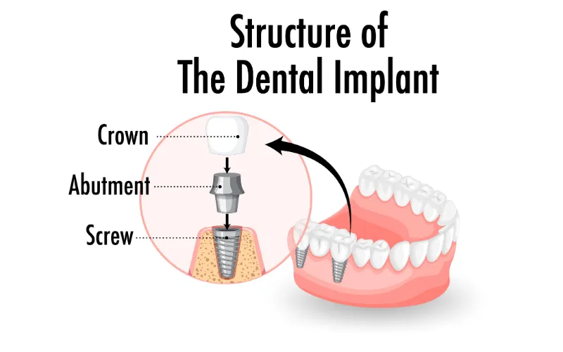 Dental implant structure showing crown, abutment, and screw components in a detailed diagram