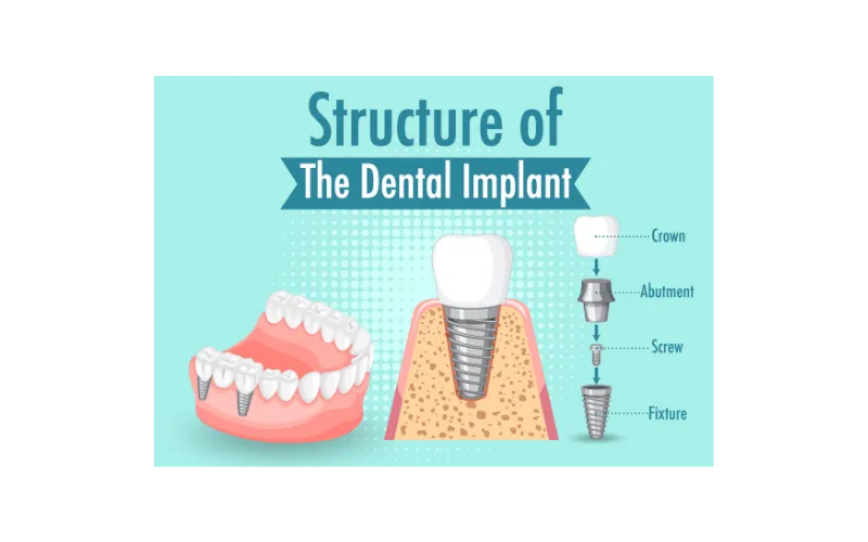 Structure of a dental implant showing crown, abutment, screw and titanium fixture in the jawbone