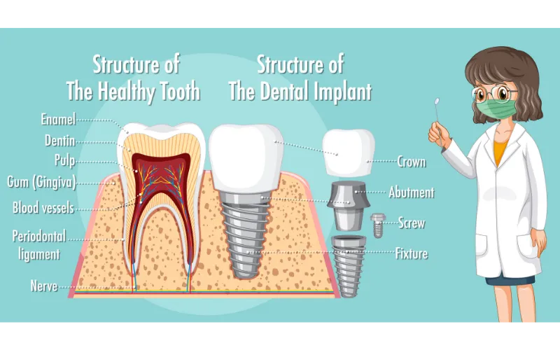 Diagram showing the structure of a healthy tooth compared to a dental implant including crown, abutment and implant fixture