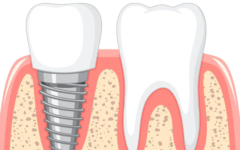 Comparison of dental implant and natural tooth structure showing titanium implant placed in jawbone