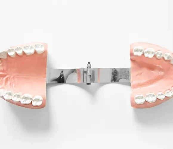 Dental Implants vs Dentures: Which One Feels More Natural?