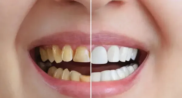 Composite bonding before and after dental treatment